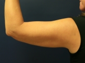 Feel Beautiful - Thermi to Arms - After Photo